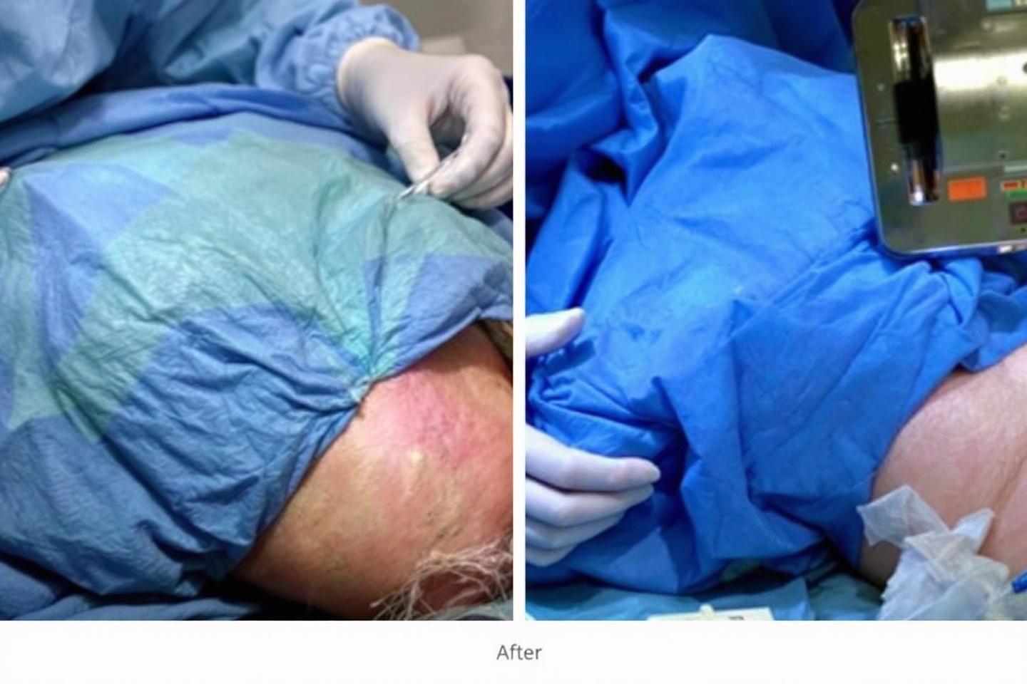 Photos avant après abdominoplastie et chirurgie esthétique du ventre