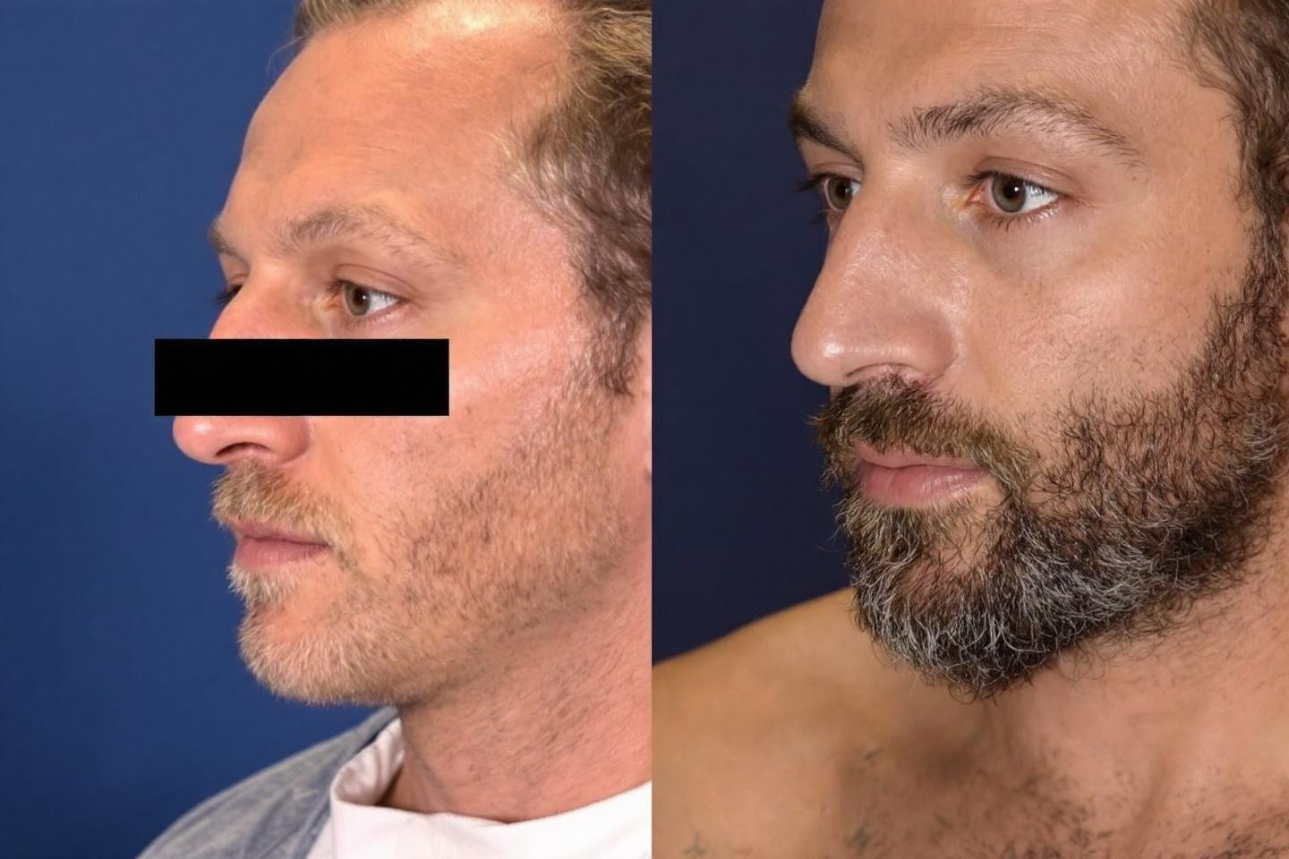 Photos avant après homme : visage, rhinoplastie et gynécomastie
